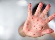 Cegah Campak, Agam Kerahkan Petugas Medis di 23 Puskesmas