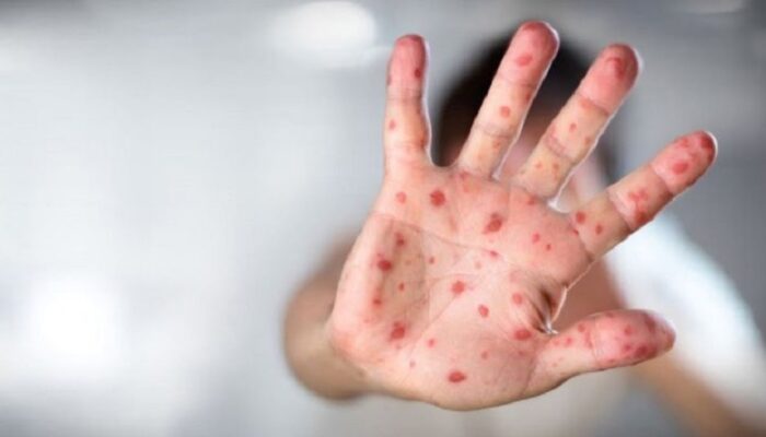 Kasus Campak Meningkat, Pemkab Agam Lakukan Imunisasi Tambahan di 8 Kecamatan