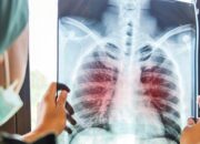 Dokter Sebut Perokok Berisiko Tinggi Terkena TBC