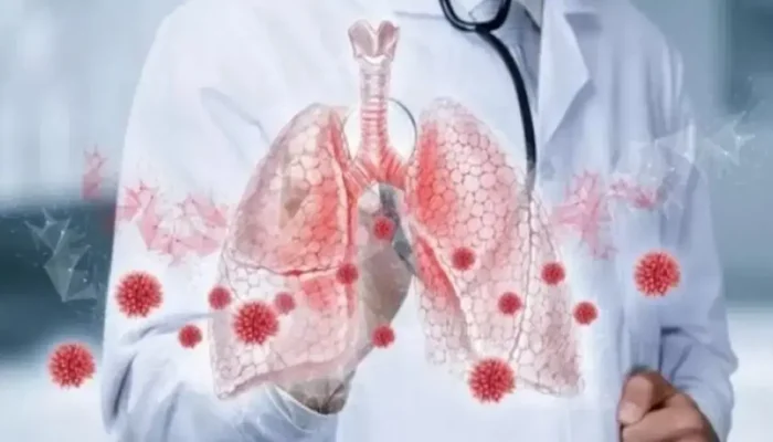 Mengenal Pneumonia Ganda, Infeksi Serius yang Serang Kedua Paru-paru