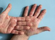 Ilustrasi penyakit campak. (dok. istimewa)