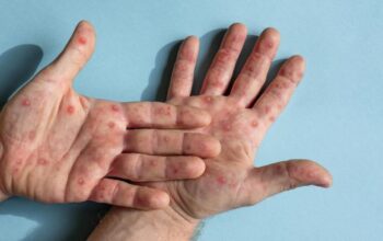 Ilustrasi penyakit campak. (dok. istimewa)