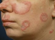 Wanita Lebih Rentan Terkena Lupus, Ini Penyebab dan Gejalanya