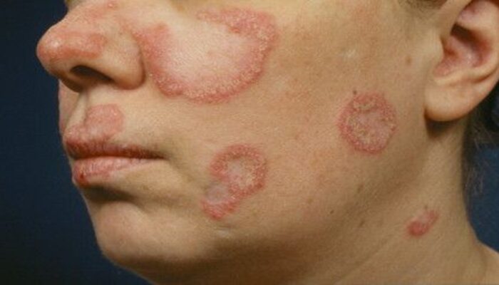 Wanita Lebih Rentan Terkena Lupus, Ini Penyebab dan Gejalanya