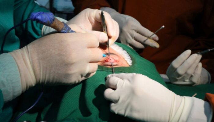 Blepharoplasty Membantu Mengatasi Kelopak Mata Kendur, Benarkah?